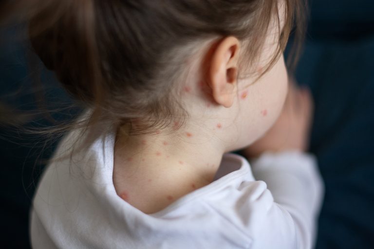 Los pediatras advierten del aumento de incidencia y de brotes localizados de sarampión